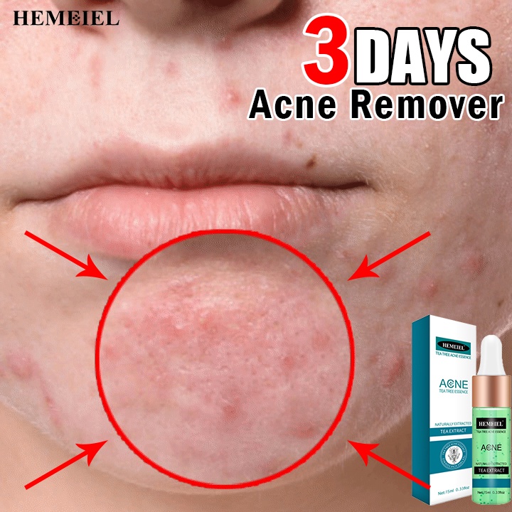 HEMEIEL Tea Tree Oil Acne Treatment Serum Anti Acne Scar Removal Cream