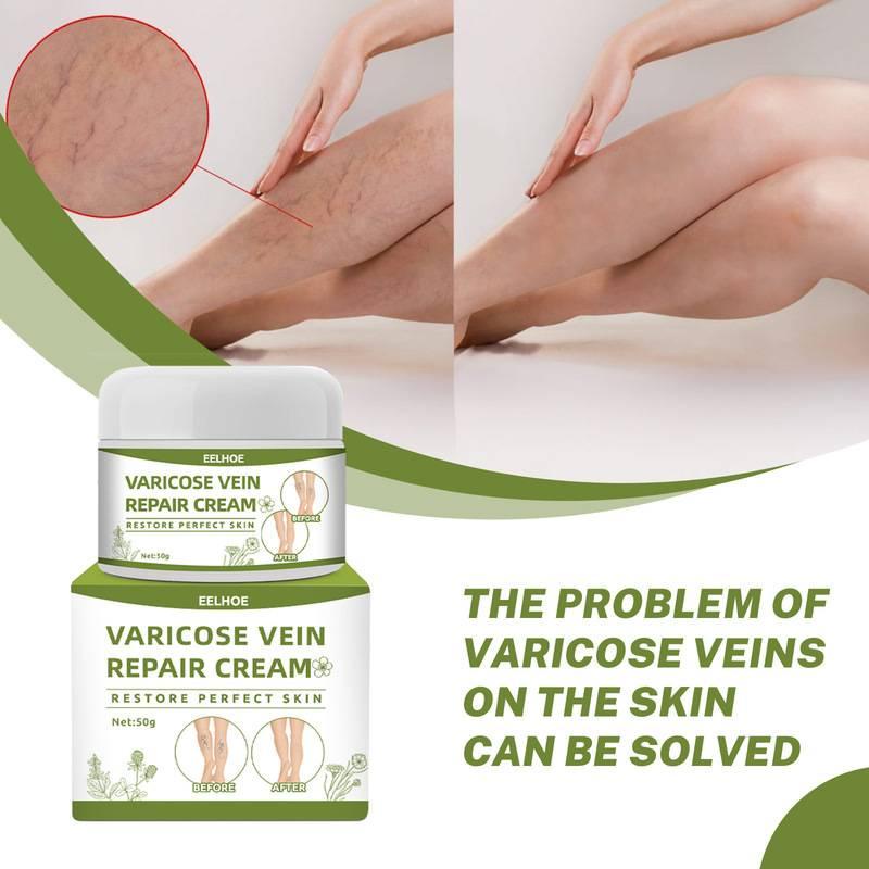 Varicose Vein Cream Leg Swelling Care Cream 50g Varicosity Angiitis ...