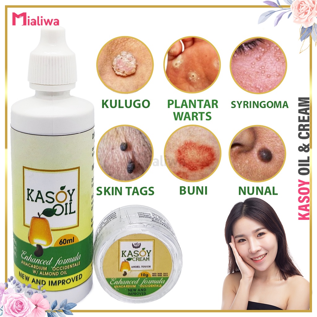 Kasoy Oil & Cream Warts Remover, Pure Organic Cashew Nut Oil & Kasoy ...