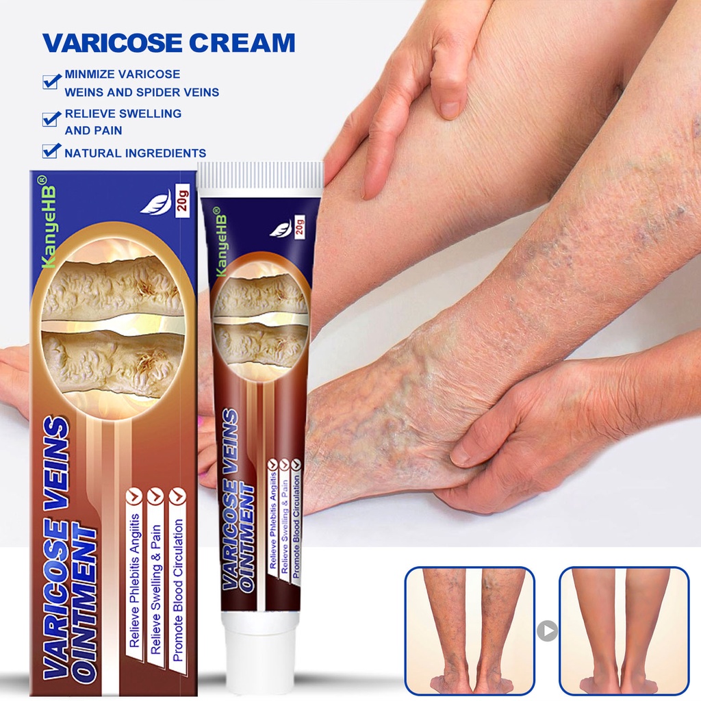 varicose vein remover varicose vein remover cream Varicose GelVeins ...