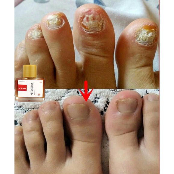 Nail Fungus Treatment Nail Antifungal Nail Repair Stop Fungal Growth