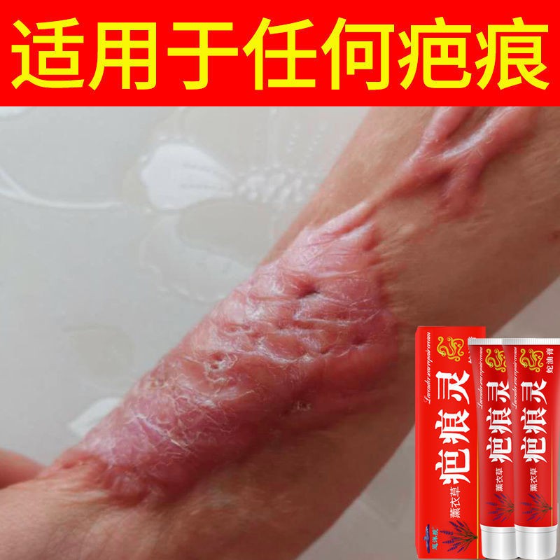 [Old Scar Buster] Scar cream to remove scars to repair scars on the