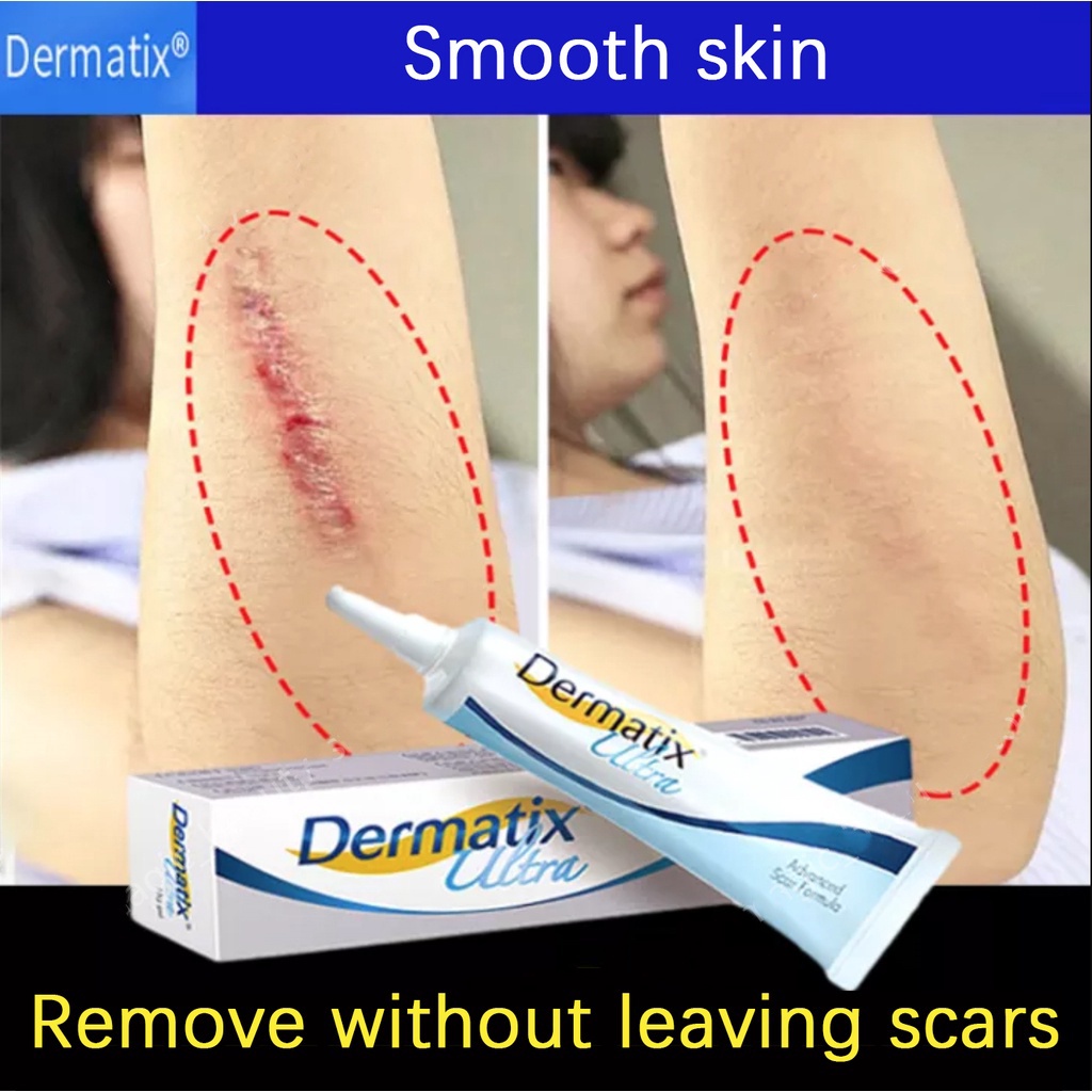 Dermatix Effective Scar Removal Cream Scar Gel Old Scars Acne Scars