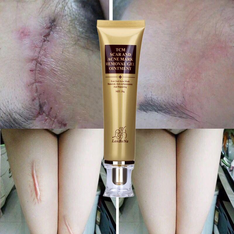LANBENA Original TCM Acne Scar Removal Cream Blackhead Pimple Stretch ...