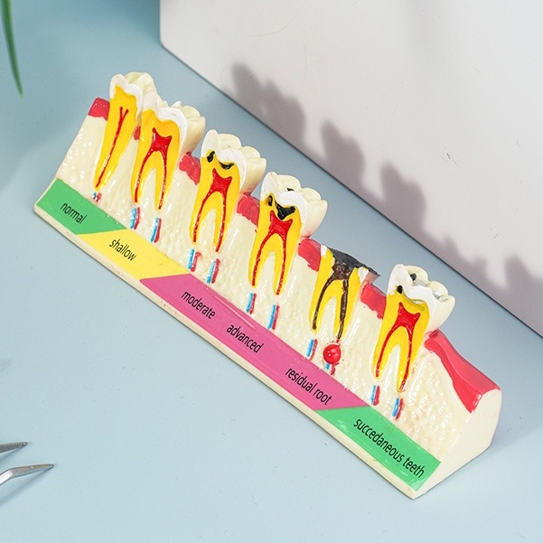 Dental caries classify tooth demonstration model teach study evolution