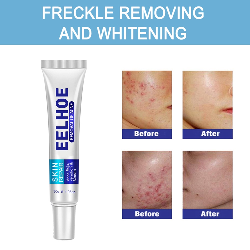Eelhoe acne Scar Cream 30g acne Treatment Gel acne Removal Cream acne