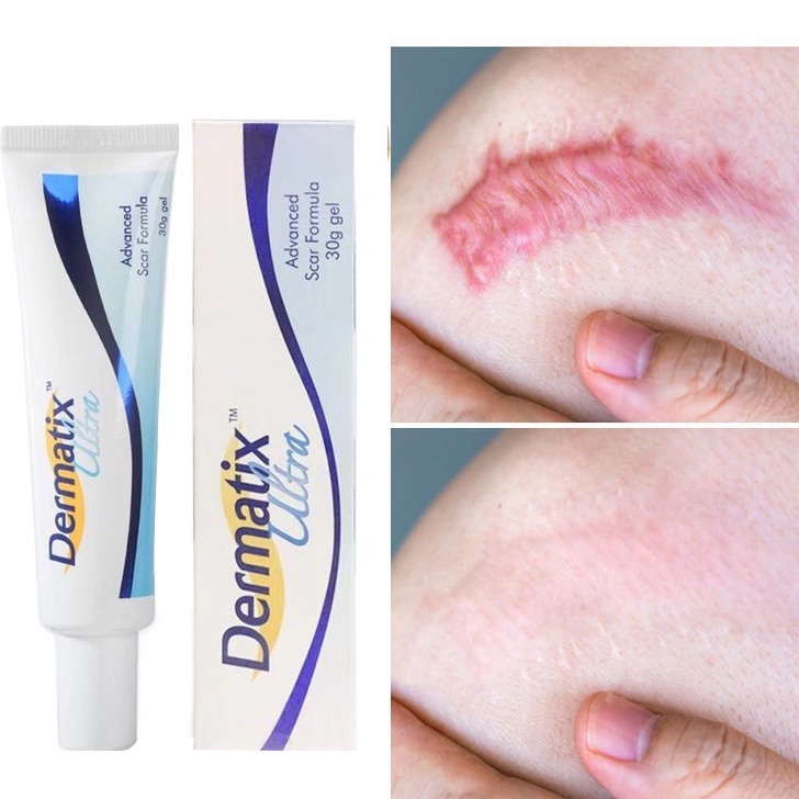 Dermatix Effective Imported Scar Remover Gel Acne Scar Treatment Scar Remover Old Scar Removal
