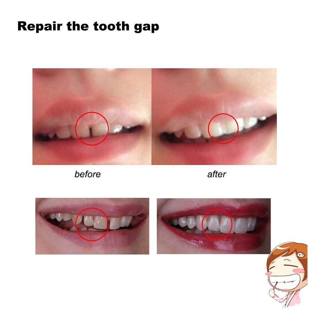 JONYE Tooth Replace Material Beauty Tooth Repair Oral Cavity Dentistry ...