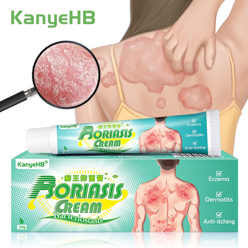Dermatitis Psoriasis Antifungal Treatment Eczema Cream Skin Itch ...