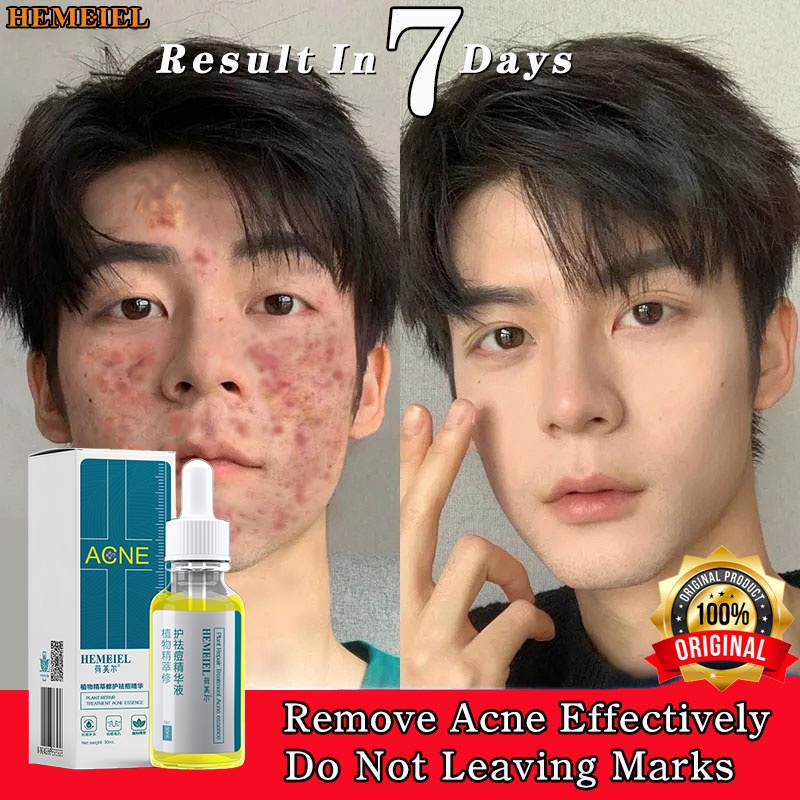 HEMEIEL Acne Treatment Serum/Adapalene Clindamycin/Pimple Marks Remover