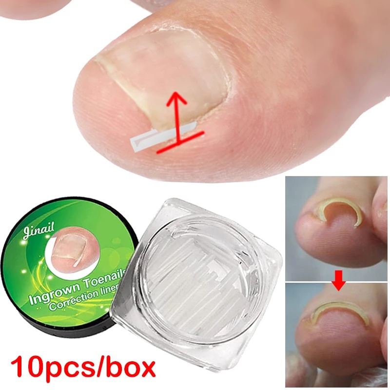 10Pcs Professional Ingrown Toenail Correction Tool / Ingrown Toenail