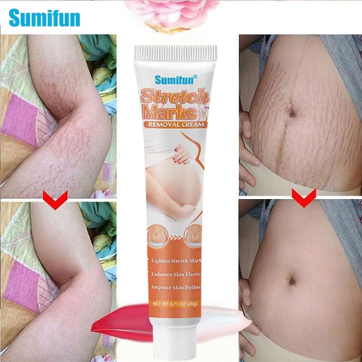 Sumifun Scar Remover Scarminator Cream 20g Stretch Mark Remover