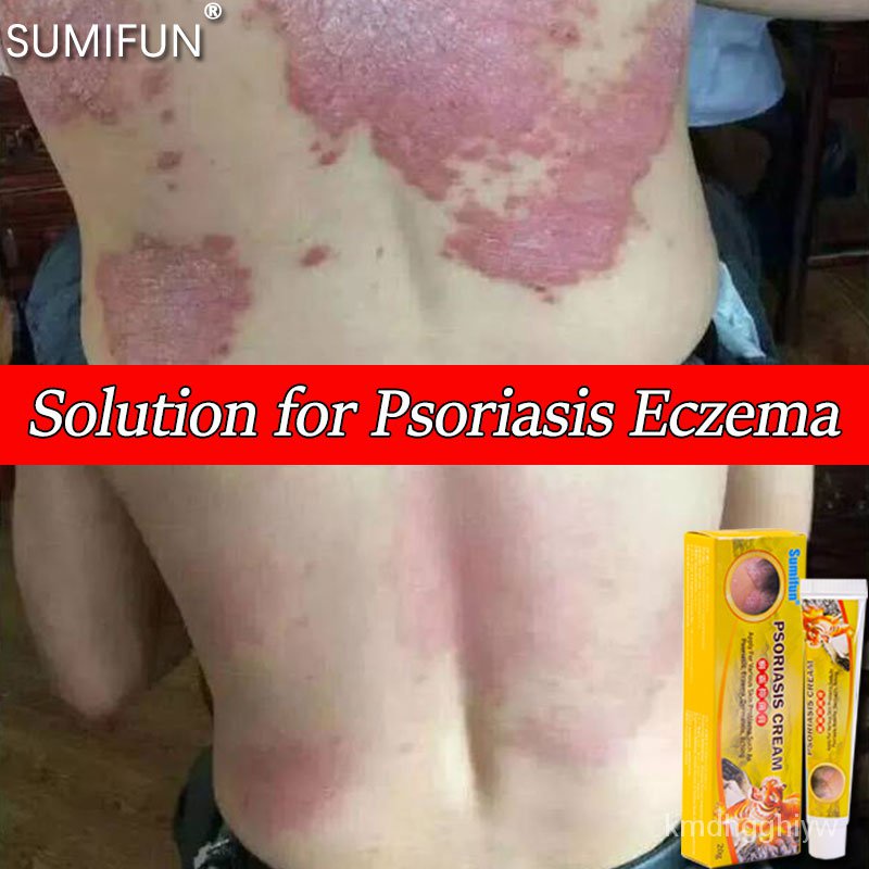 Sumifun psoriasis and eczema treatment ointment 20g Relieve and treat