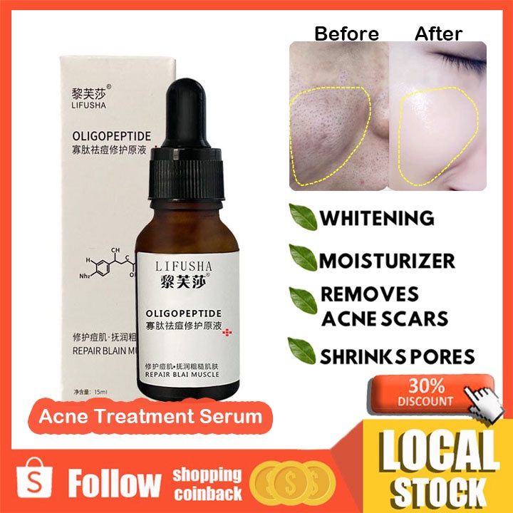 LIFUSHA Acne Pimple Eraser Treatment Toner Anti-infection Quick Pimple ...