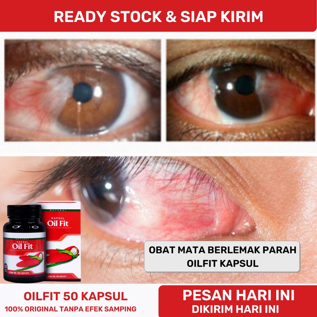 MATA Fatty Eye Medicine, Pterigium, Fatty And Opaque Eye Medicine ...