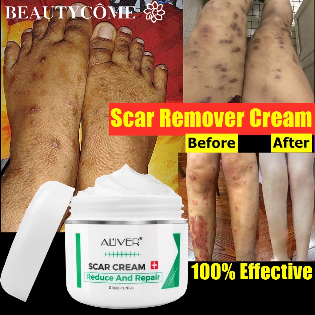 ALIVER old Scar Remover for legs 50ml peklat remover acne Surgical