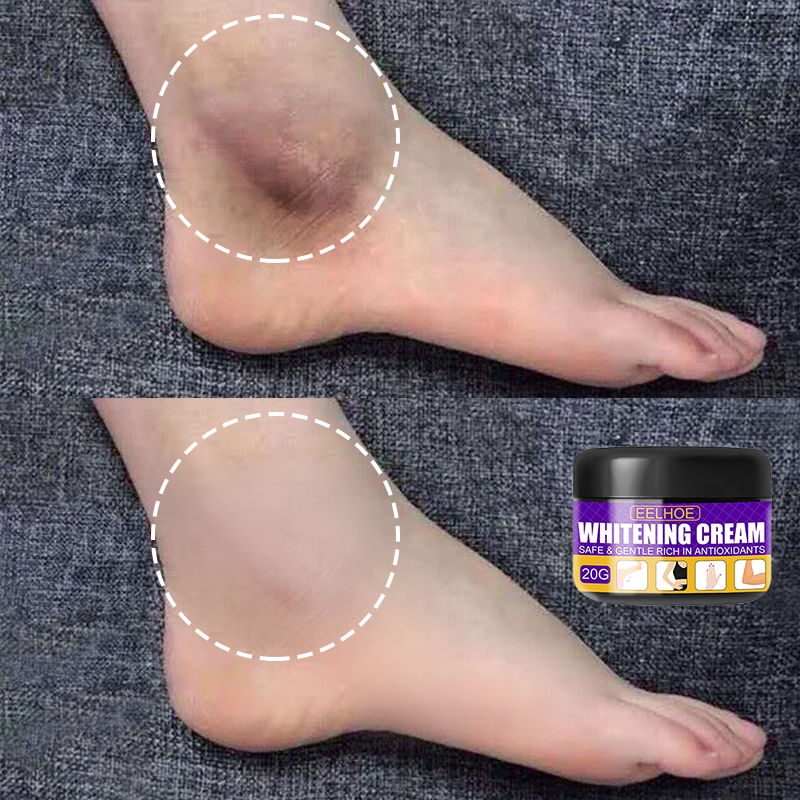 Knee Whitening Whitening Body Cream Knee Whitening Cream Body Bleaching