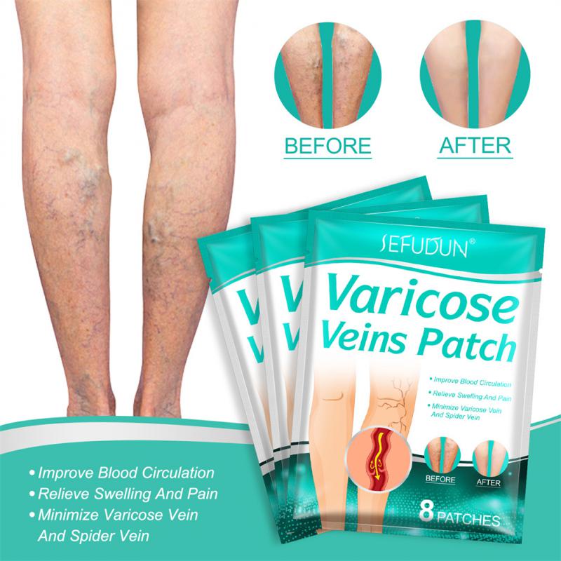 SEFUDUN Varicose Veins Plaster Vasculitis Phlebitis Earthworm Leg Patch ...