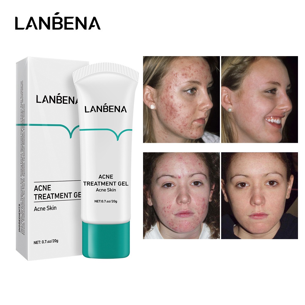 LANBENA Acne Treatment Cream - Acne Spot Prone Gel Remove Blackhead