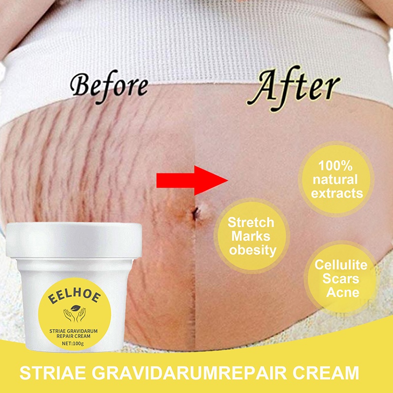 Acne Scar Stretch Marks Remover Cream Postpartum Firming Skin Repair