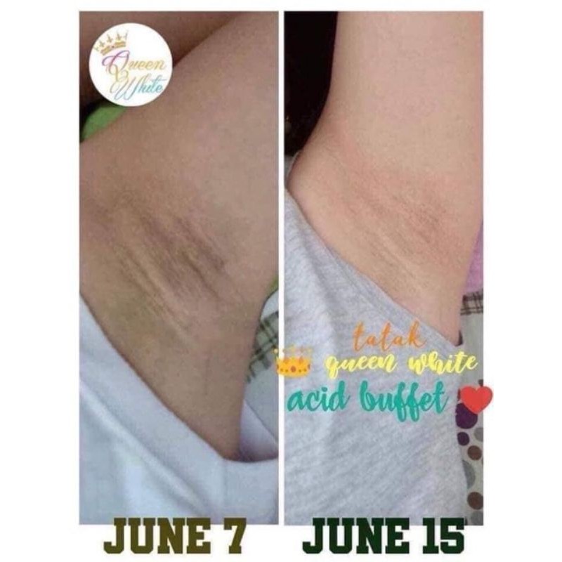 Queen White Acid Buffet Concentrated Serum | Shopee Philippines