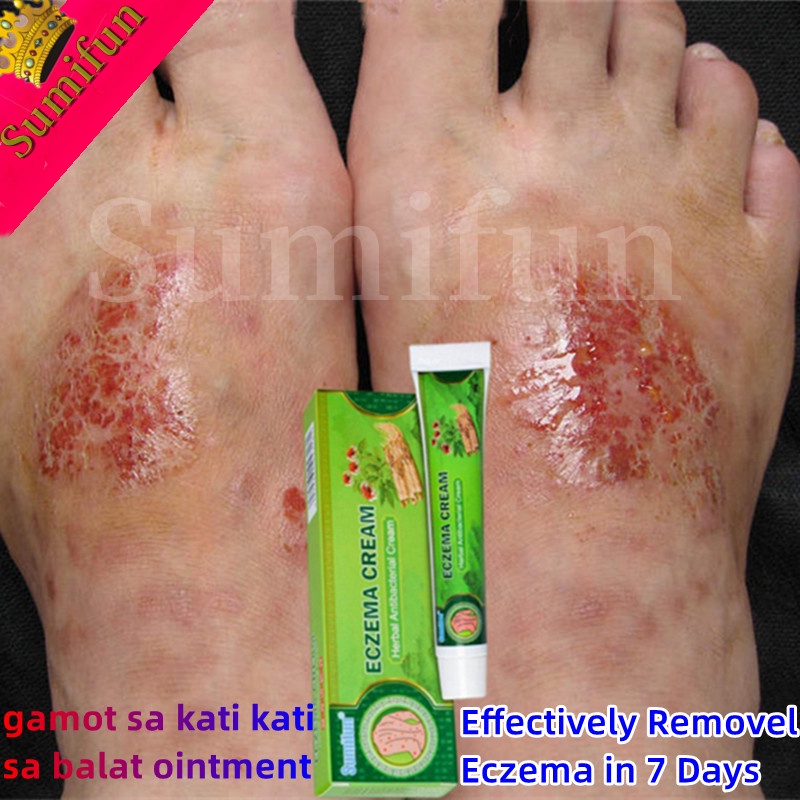 Eczema Cream Psoriasis Cream Gamot Sa Kati Kati Sa Balat Ointment For Itchy Skin And Allergy 6810