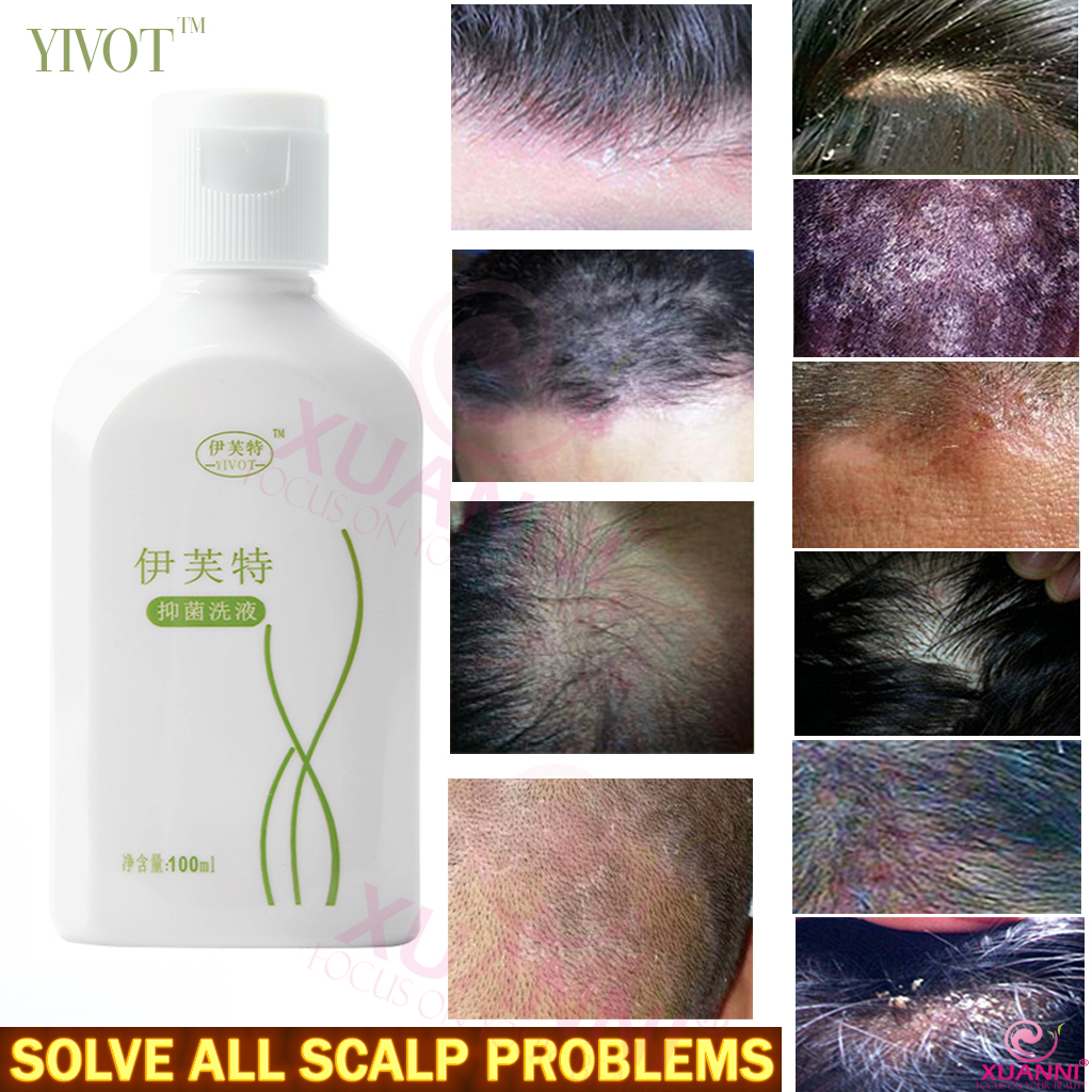 Authentic Hundre Herbal Vivot Scalp Folliculitis Red And Swollen Acne Anti Dandruff And