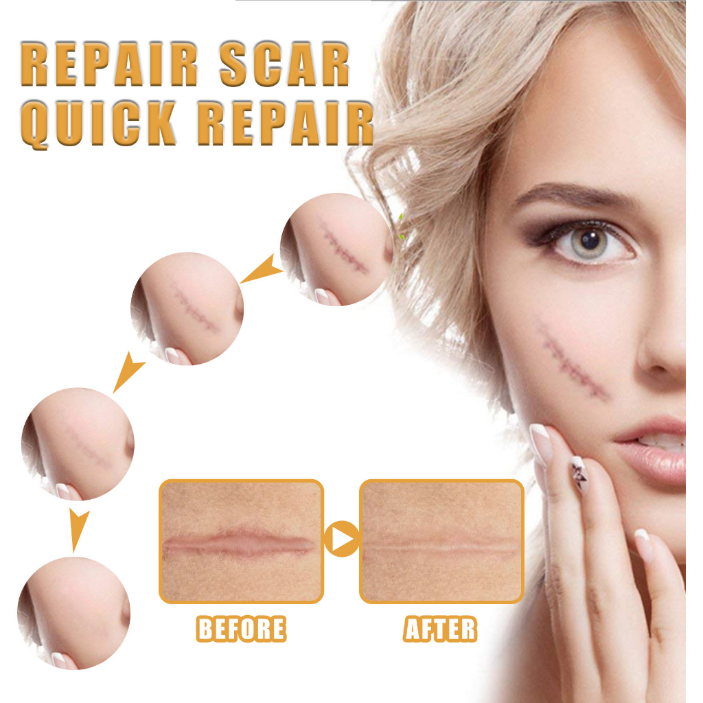 Effective Scar Remover Cream For Old Scar On Leg Scars Repair Stretch