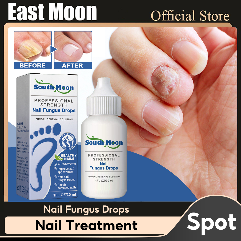Nail Fungus Treatment Solution Anti Infection Paronychia Onychomycosis