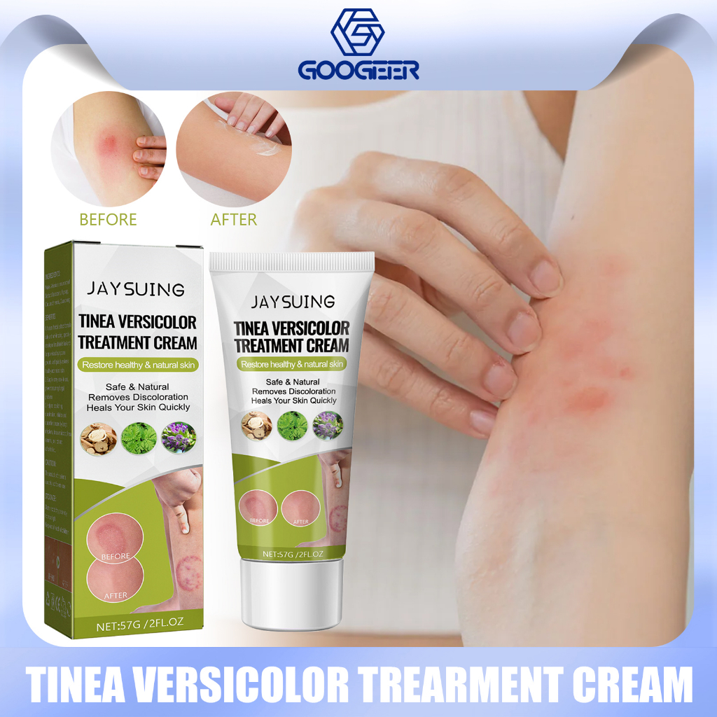 South Moon Tinea Versicolor Repair Ointment Hand Body Tinea Anti-Itch ...