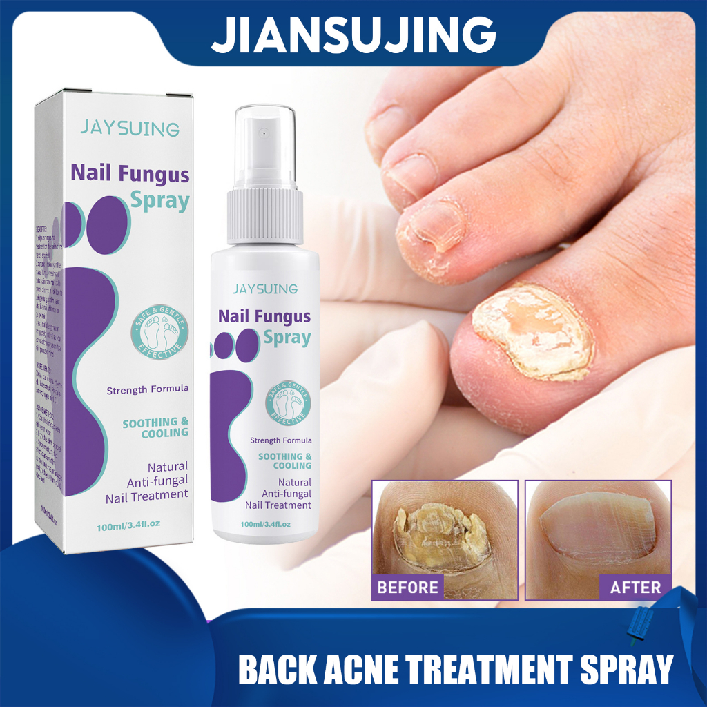 Jaysuing Nail Fungal Treatment Anti Paronychia Relief Oil Spray Nail