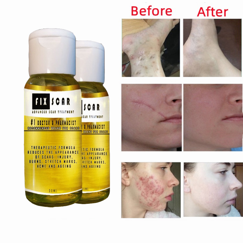 scar remover for old scar on leg Original Fixscar Advance Fix Scar Gel