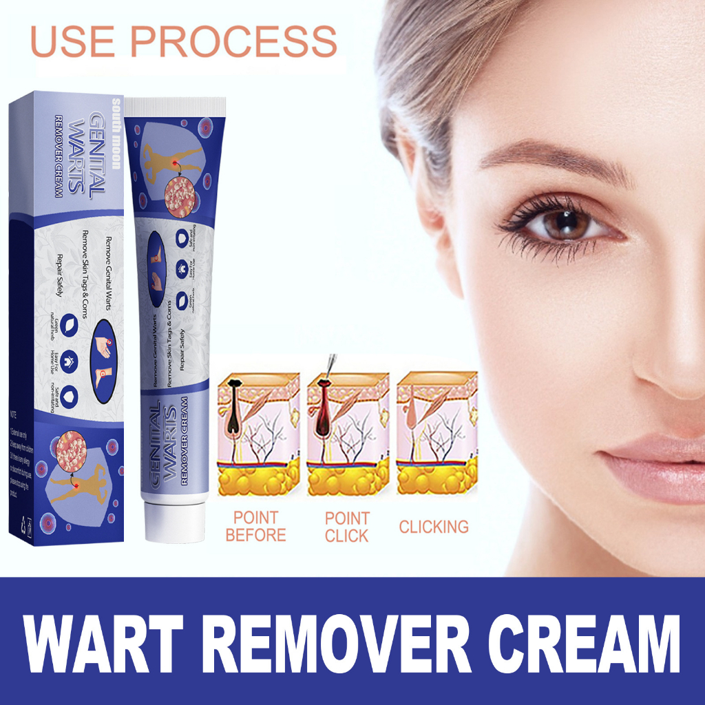 Warts Remover Original Kasoy Oil Cream Mole Skin Tag Wart Remover ...