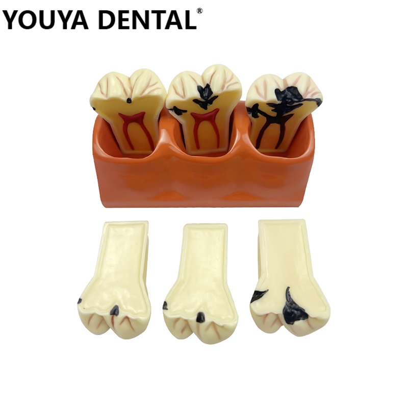 4 Times Dental Anatomy Education Teeth Model Caries Comparation Study ...