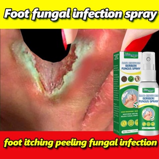 15g Natural Foot Tinea Pedis Treat Ointment Antipruritic Deodorant