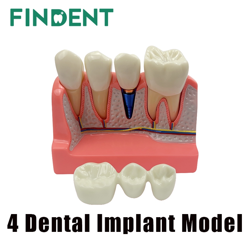 Dental Implant Model for Patient Education 4 Times Dental Implant Crown