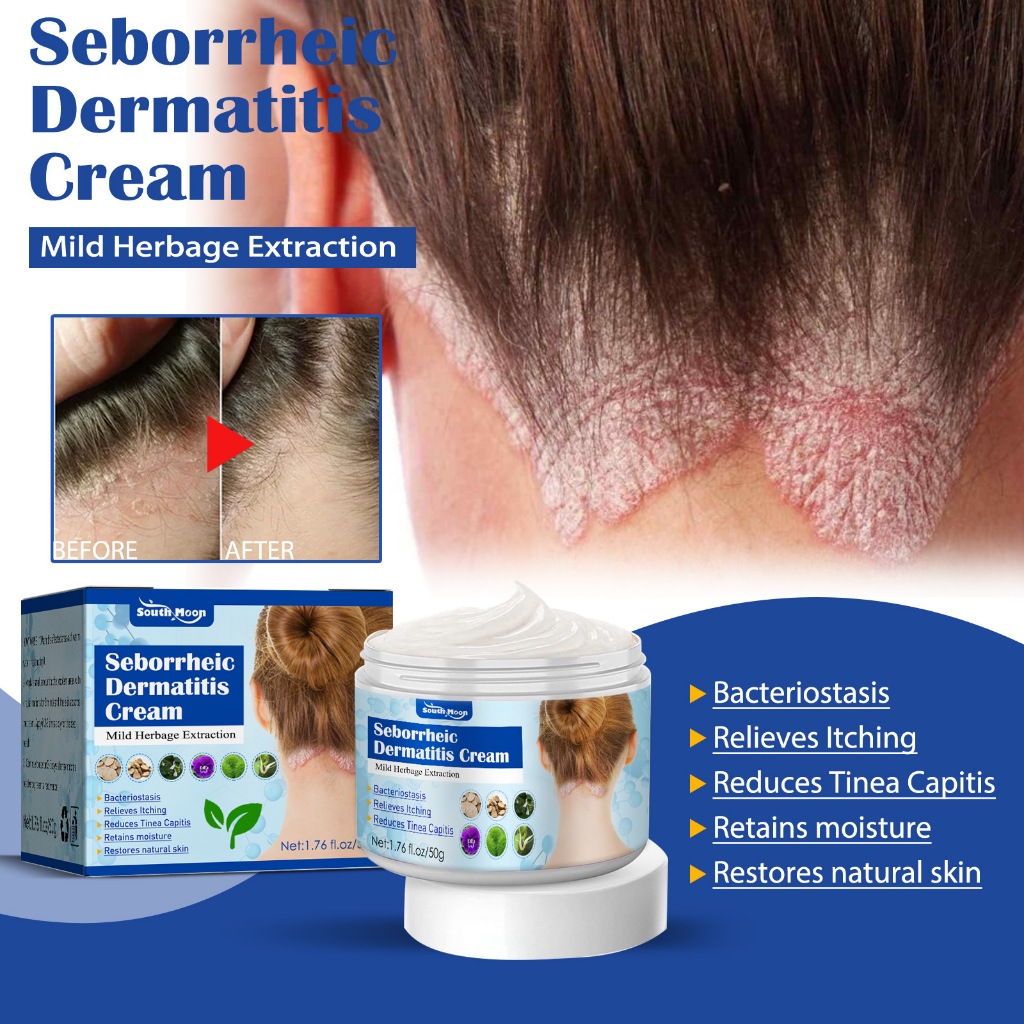Anti-Itch Cream Seborrheic Dermatitis Cream Head Acne Itchy Scalp ...