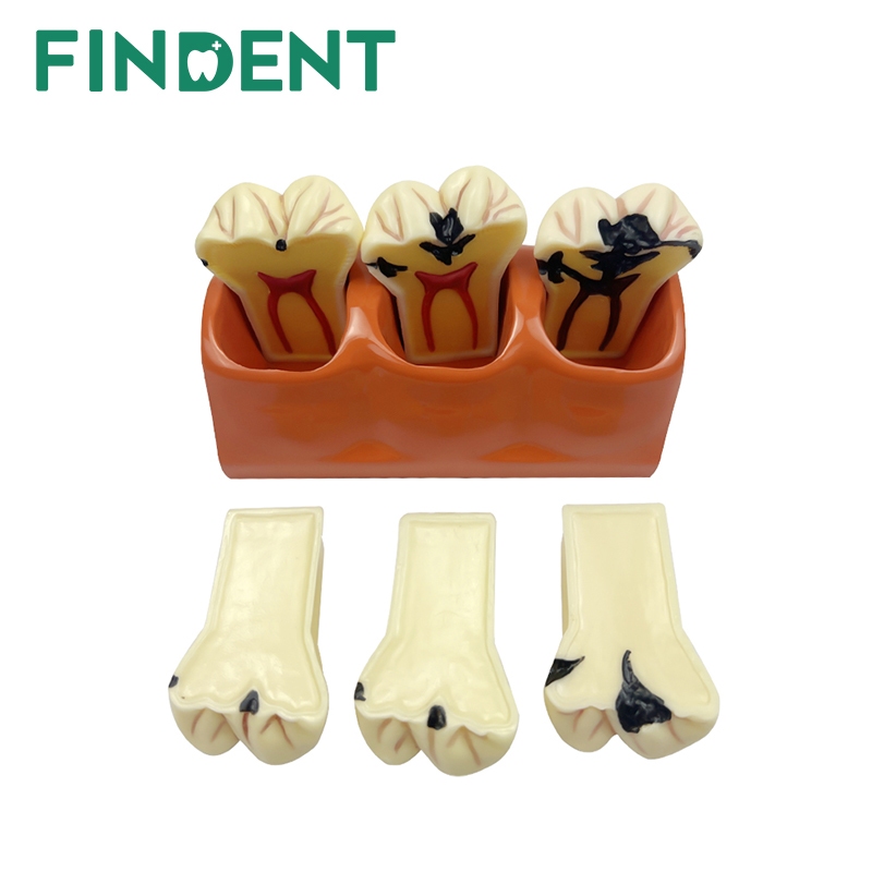 Dental Caries Teeth Model 4 Times Dental Tooth Decay Model Caries