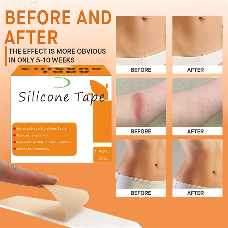 Silicone Scar Tape Remove CSection Surgery Burn Keloid Acne Marks Repair Skin Selfadhesive