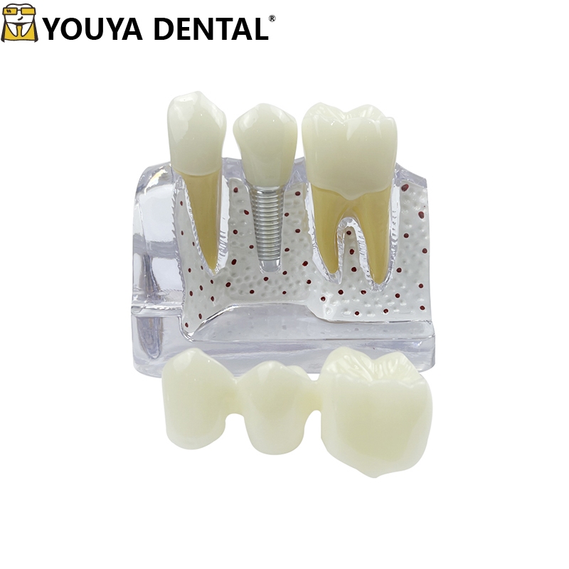 Dental Model Resin Transparent 4times Tooth Implant Model For Dentist ...