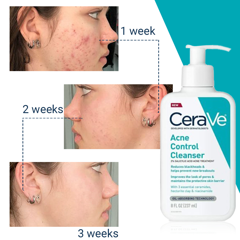 CeraVe Acne Control Cleanser 237ml 2 Salicylic Acid Acne Treatment