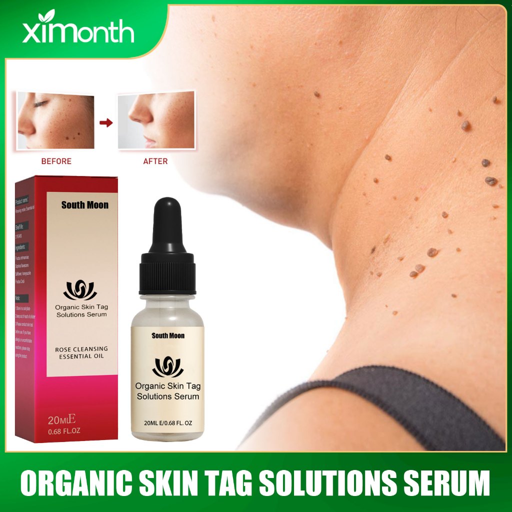 Ximonth Organic Skin Tag Solutions Serum Painless Mole Skin Dark Spot  Removal Serum Face Wart Tag Freckle Removal Oil Skin Care | Shopee  Philippines