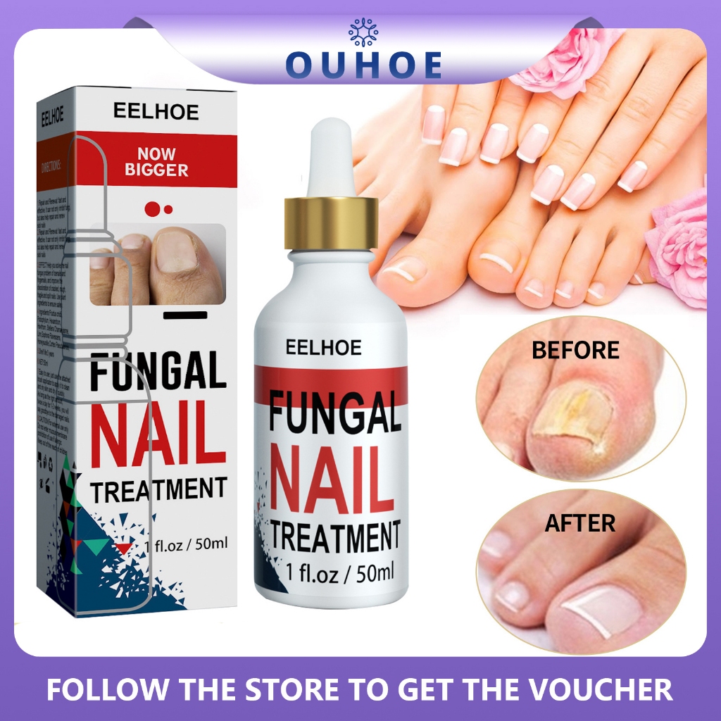 Eelhoe Fungal Nail Treatment Essence Serum 50ml Anti Infection