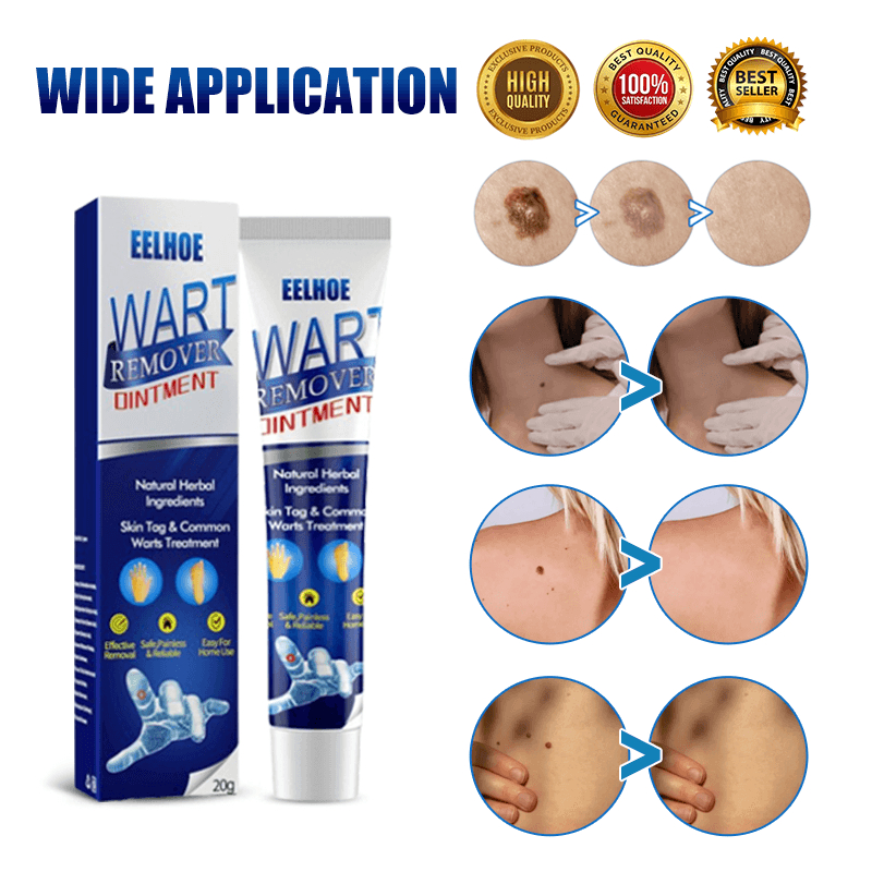 Warts Remover Original Cream Wart Removal Ointment Kulugo Skin Tags ...