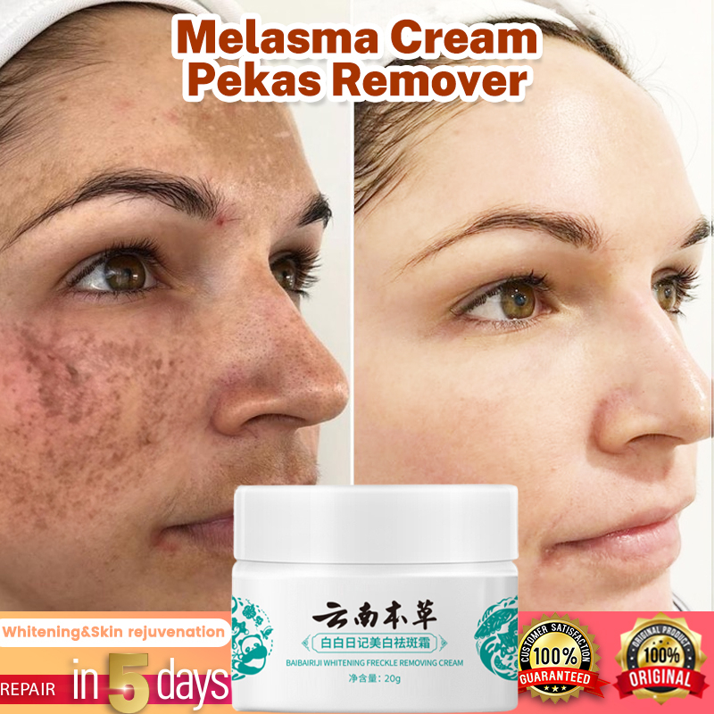 Freckle Whitening Cream 20G Melasma Pekas Remover Blemish Cream Sunburn