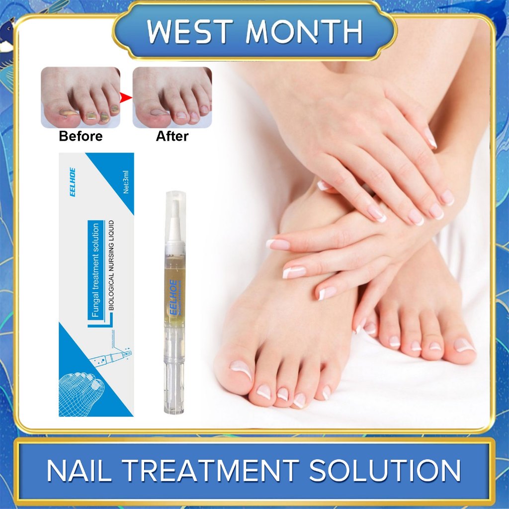 Eelhoe Fungal Nail Treatment Pen Effective Onychomycosis Paronychia ...