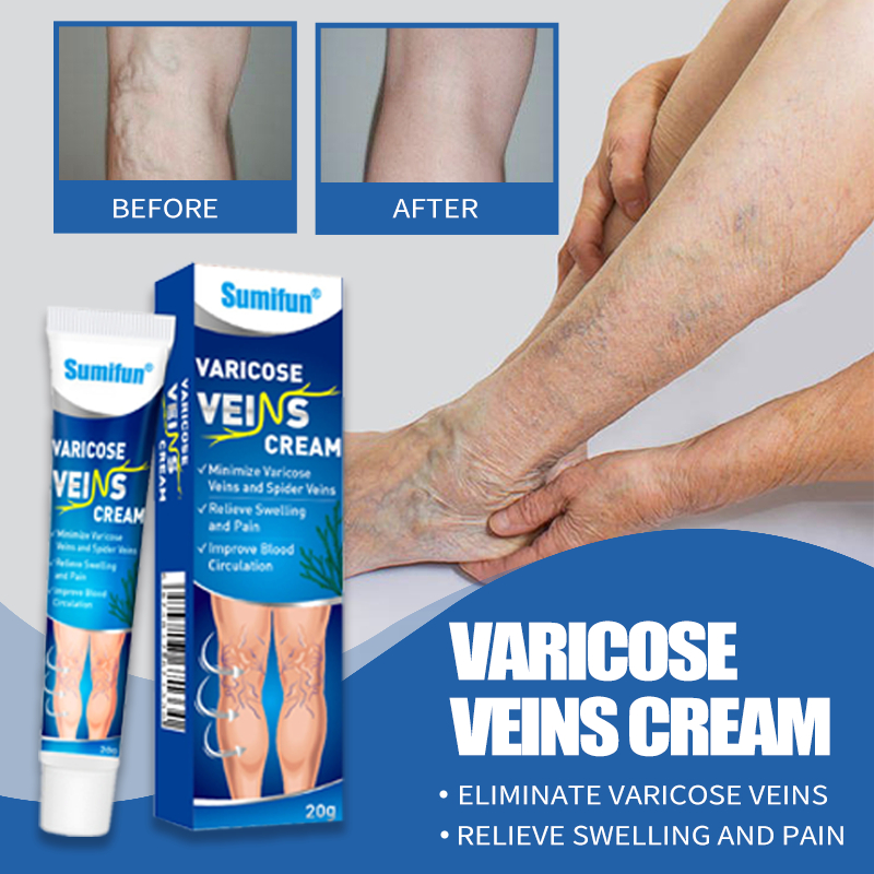 effective remover Varicose veins cream original varicose treatment ...