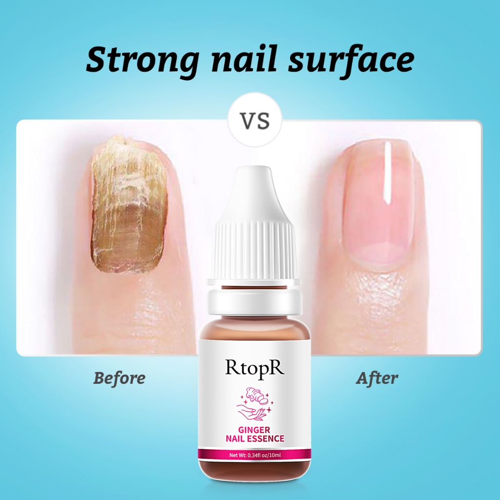 RtopR FDA 10% Zingiber Officinaleginger Ginger Antibacterial Nail ...