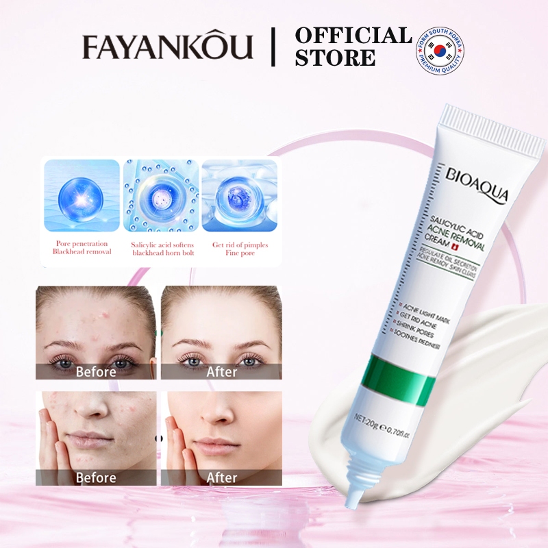 Picture of Acne: Types, Causes, Treatment & Prevention - Cleveland Clinic