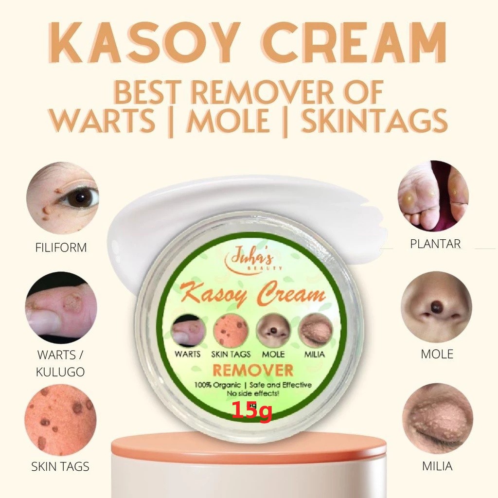 100% Original Kasoy Cream Remover | Mole Remover | Warts Remover | Skin ...